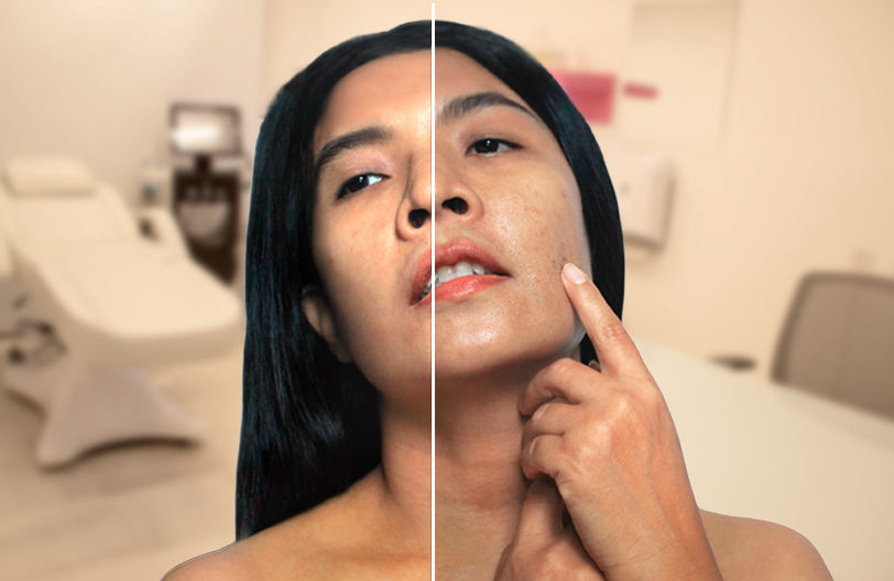 mejora las cicatrices de acné